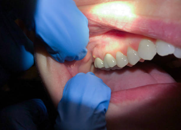 Best Emergency Treatment for Dental Infections or Abscesses in Graham, NC
